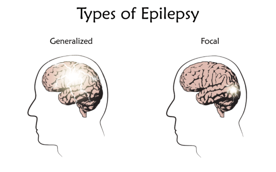 Epilepsie se dělí na 2 základní typy, a sice generalizovaná (postihuje velkou část mozku naráz) a fokální (postihuje specifické místo, ohnisko, v mozku)